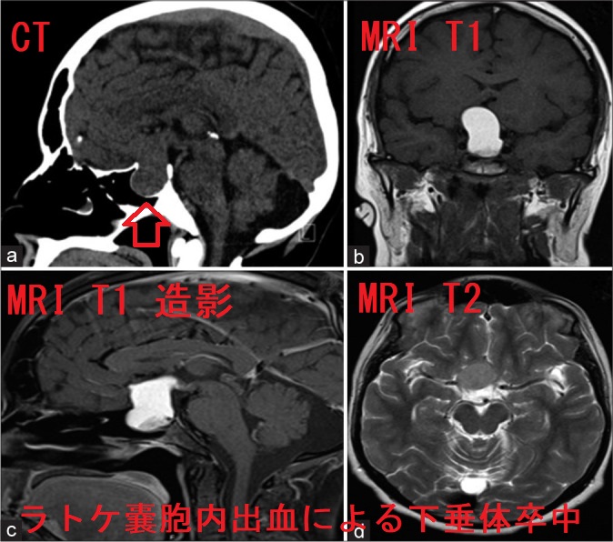 ラトケ嚢胞内出血による下垂体卒中 ラトケ嚢胞内出血による下垂体卒中