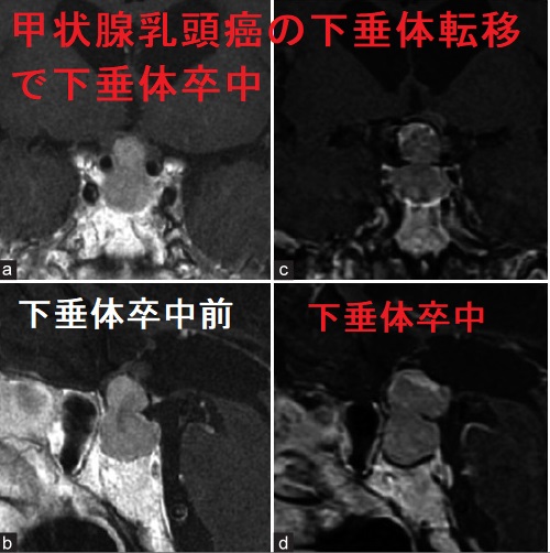 甲状腺乳頭癌の下垂体転移で下垂体卒中 甲状腺乳頭癌の下垂体転移で下垂体卒中