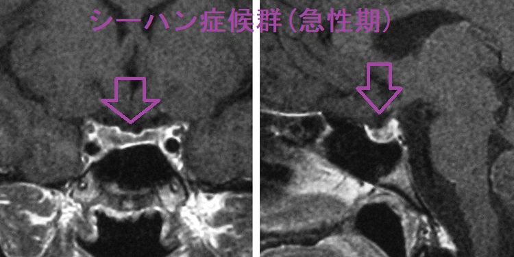 分娩後26日のシーハン症候群(急性期)造影MRI T1強調画像 分娩後26日のシーハン症候群(急性期)造影MRI T1強調画像