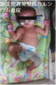 新生児遅発型低カルシウム血症 新生児遅発型低カルシウム血症