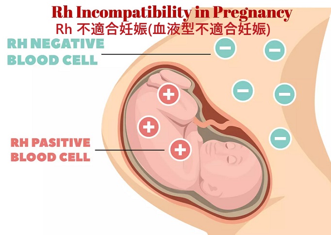 Rh 不適合妊娠(血液型不適合妊娠) Rh 不適合妊娠(血液型不適合妊娠)