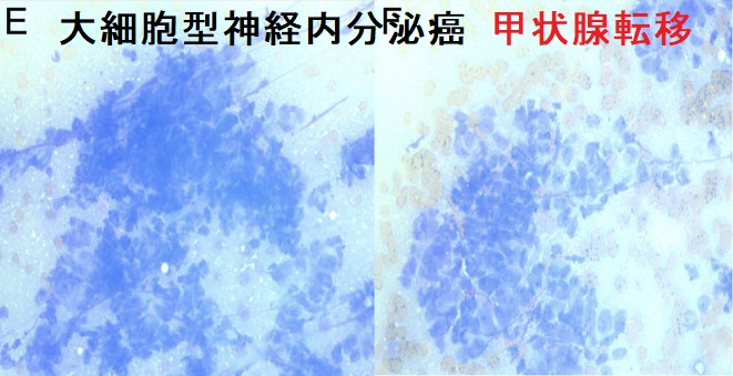 大細胞型神経内分泌癌 甲状腺転移 大細胞型神経内分泌癌 甲状腺転移