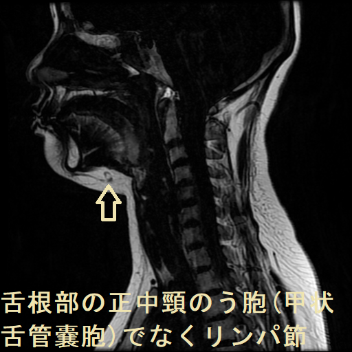 舌根部の正中頸のう胞(甲状舌管嚢胞)でなくリンパ節 MRI 矢状断 舌根部の正中頸のう胞(甲状舌管嚢胞)でなくリンパ節 MRI 矢状断