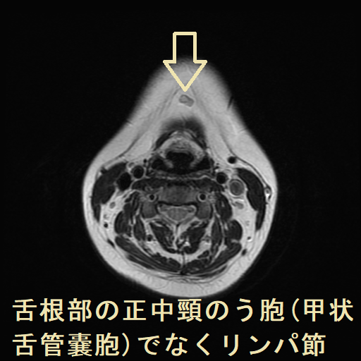 舌根部の正中頸のう胞(甲状舌管嚢胞)でなくリンパ節 MRI 水平断 舌根部の正中頸のう胞(甲状舌管嚢胞)でなくリンパ節 MRI 水平断