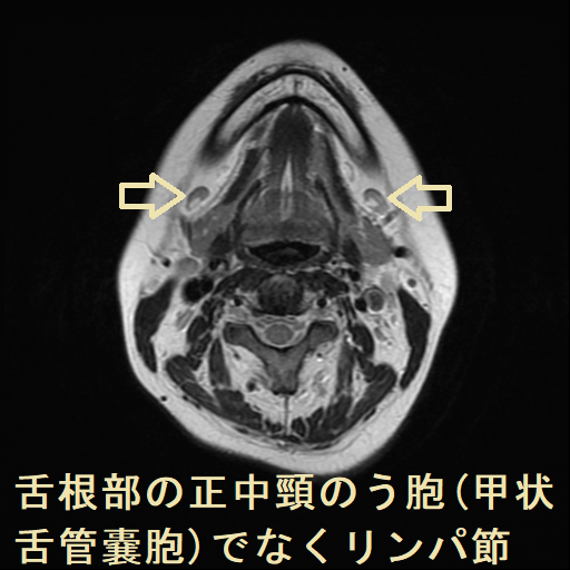 舌根部の正中頸のう胞(甲状舌管嚢胞)でなくリンパ節 MRI その他リンパ節2 舌根部の正中頸のう胞(甲状舌管嚢胞)でなくリンパ節 MRI その他リンパ節2