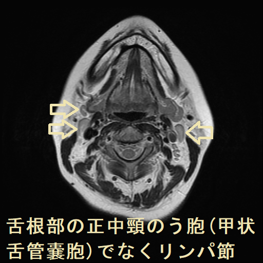 舌根部の正中頸のう胞(甲状舌管嚢胞)でなくリンパ節 MRI その他リンパ節1 舌根部の正中頸のう胞(甲状舌管嚢胞)でなくリンパ節 MRI その他リンパ節1
