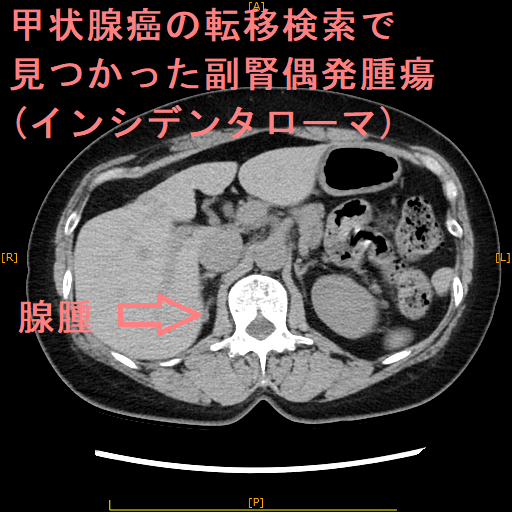 甲状腺癌の転移検索で見つかった副腎偶発腫瘍(インシデンタローマ) 腺腫 甲状腺癌の転移検索で見つかった 副腎偶発腫瘍(インシデンタローマ) 腺腫