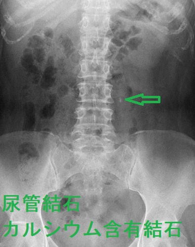 尿管結石 カルシウム含有結石 尿管結石 カルシウム含有結石