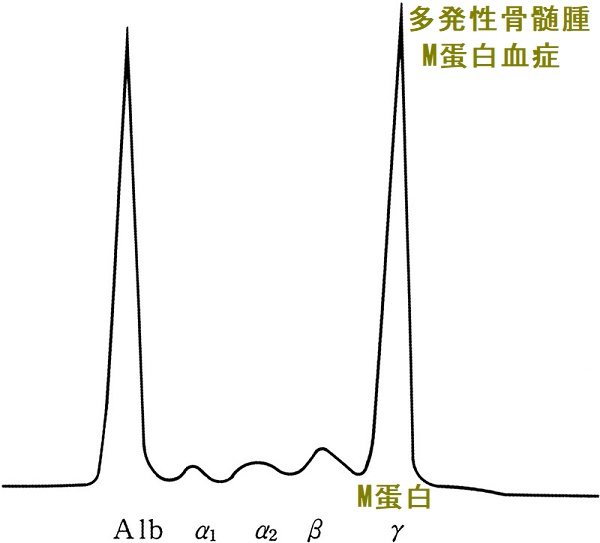 多発性骨髄腫 M蛋白血症 多発性骨髄腫 M蛋白血症