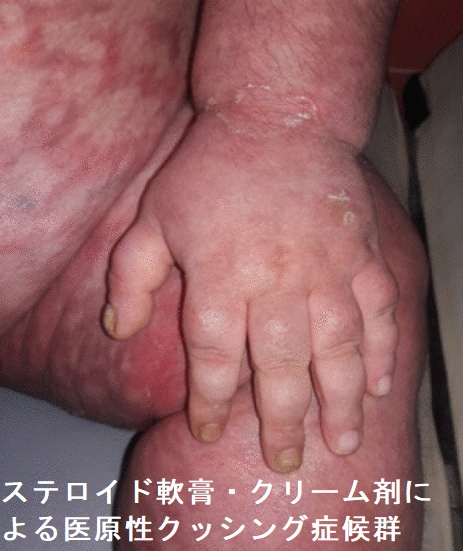 ステロイド軟膏・クリーム剤による医原性クッシング症候群 ステロイド軟膏・クリーム剤による医原性クッシング症候群