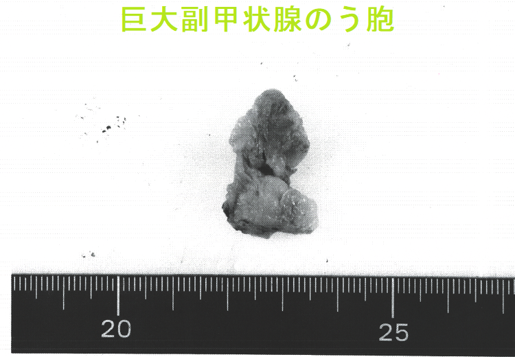 巨大副甲状腺のう胞(巨大副甲状腺嚢胞)手術標本1 巨大副甲状腺のう胞(巨大副甲状腺嚢胞)手術標本1