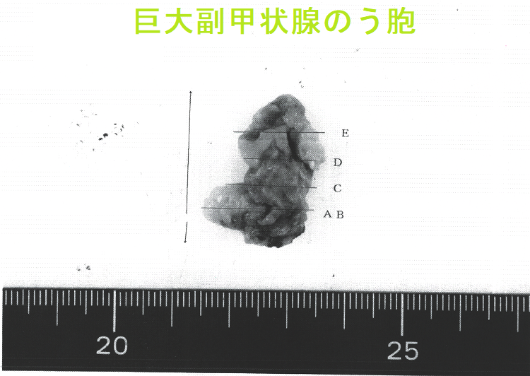 巨大副甲状腺のう胞(巨大副甲状腺嚢胞)手術標本2 巨大副甲状腺のう胞(巨大副甲状腺嚢胞)手術標本2