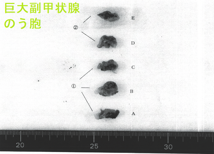 巨大副甲状腺のう胞(巨大副甲状腺嚢胞)手術標本3 巨大副甲状腺のう胞(巨大副甲状腺嚢胞)手術標本3