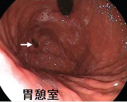 胃憩室 内視鏡画像 胃憩室 内視鏡画像