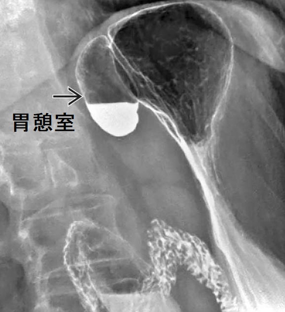 胃憩室 上部消化管造影画像 胃憩室 上部消化管造影画像