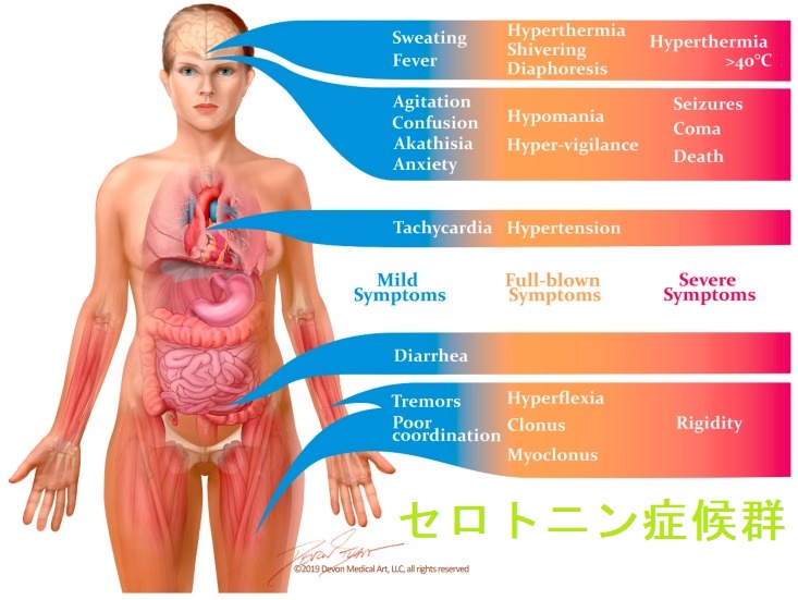 カルチノイド症候群 セロトニン症候群2