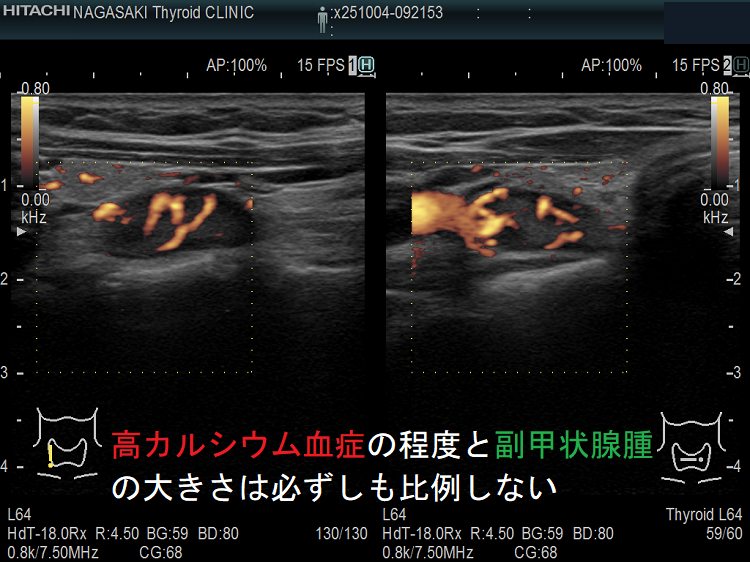 高カルシウム血症の程度と副甲状腺腫の大きさは必ずしも比例しない ドプラーモード 高カルシウム血症の程度と副甲状腺腫の大きさは必ずしも比例しない ドプラーモード