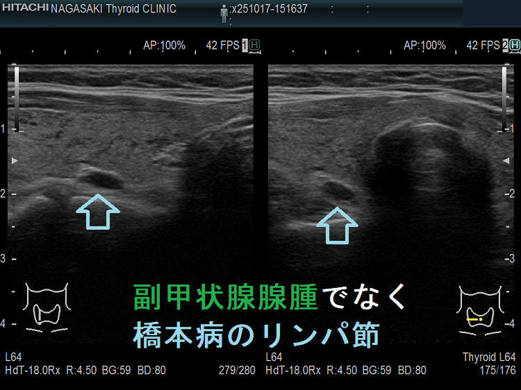 副甲状腺腺腫でなく橋本病のリンパ節 副甲状腺腺腫でなく橋本病のリンパ節1