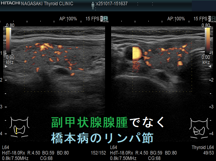 副甲状腺腺腫でなく橋本病のリンパ節 ドプラーモード 副甲状腺腺腫でなく橋本病のリンパ節 ドプラーモード