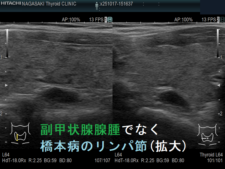 副甲状腺腺腫でなく橋本病のリンパ節(拡大) 副甲状腺腺腫でなく橋本病のリンパ節(拡大)