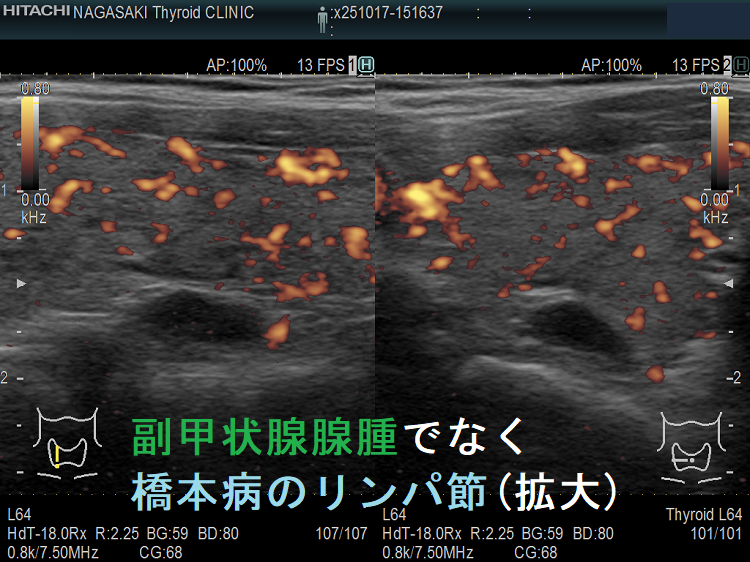 副甲状腺腺腫でなく橋本病のリンパ節 (拡大) ドプラーモード 副甲状腺腺腫でなく橋本病のリンパ節(拡大) ドプラーモード