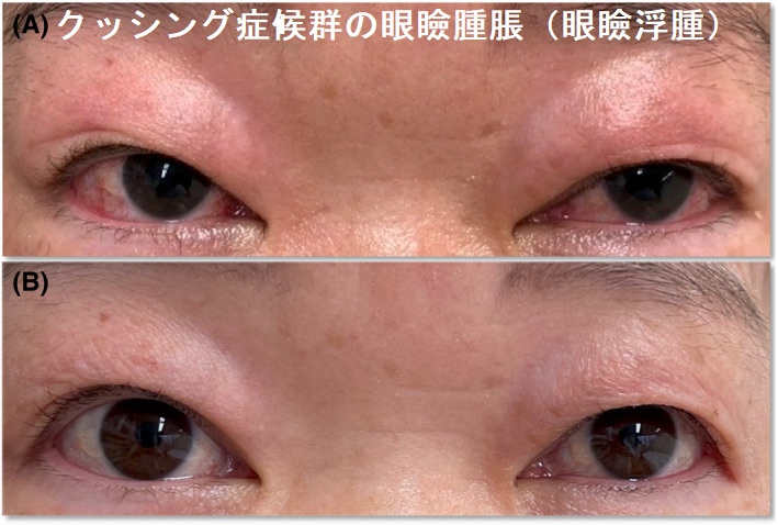 クッシング症候群の眼球突出・眼瞼腫脹(眼瞼浮腫) クッシング症候群の眼球突出・眼瞼腫脹(眼瞼浮腫)