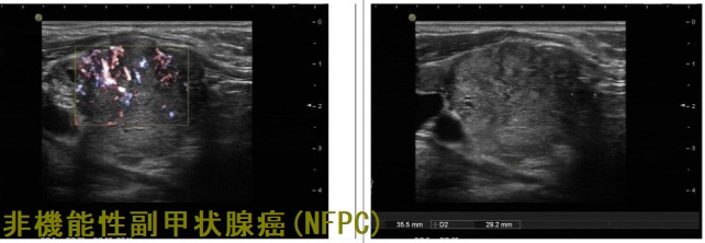 非機能性副甲状腺癌(NFPC)超音波画像 非機能性副甲状腺癌(NFPC)超音波画像