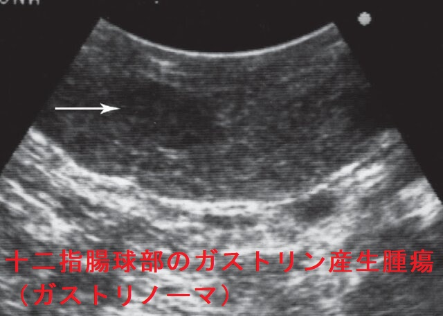 十二指腸球部のガストリン産生腫瘍(ガストリノーマ) 十二指腸球部のガストリン産生腫瘍(ガストリノーマ)