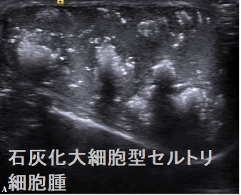 石灰化大細胞型セルトリ細胞腫 石灰化大細胞型セルトリ細胞腫