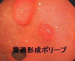胃過形成ポリ-プ 胃過形成ポリ-プ