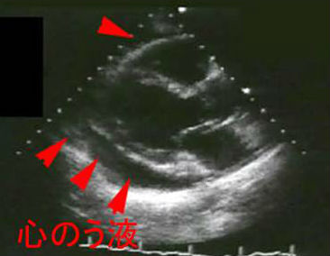 心のう液貯留 心のう液貯留