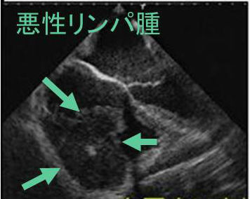 心臓原発悪性リンパ腫(びまん性大細胞性B細胞リンパ腫) 心臓原発悪性リンパ腫(びまん性大細胞性B細胞リンパ腫)
