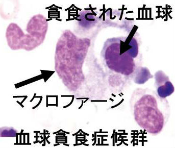 甲状腺と血球貪食症候群 甲状腺と血球貪食症候群
