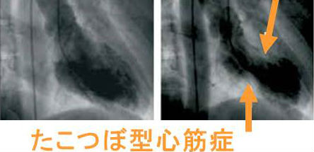 たこつぼ型心筋症 たこつぼ型心筋症
