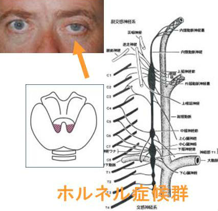 眼瞼下垂:ホルネル(ホルナー)症候群 眼瞼下垂:ホルネル(ホルナー)症候群