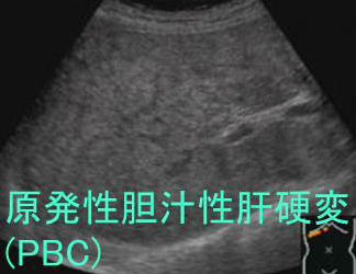 原発性胆汁性肝硬変(PBC) 超音波(エコー)画像 原発性胆汁性肝硬変(PBC) 超音波(エコー)画像