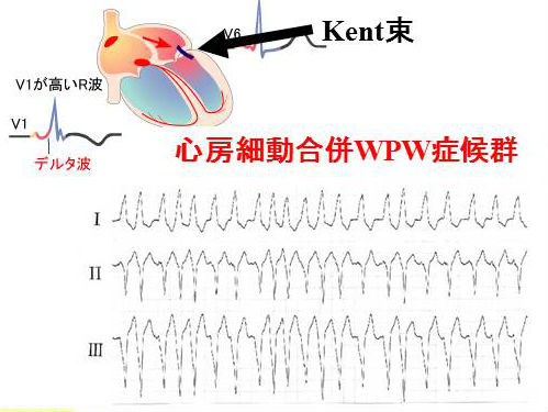 心房細動(Af)合併WPW症候群 心房細動(Af)合併WPW症候群