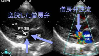 僧帽弁逸脱症 僧帽弁逸脱症
