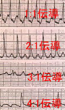 心房粗動(atrial flutter; AF) 心房粗動(atrial flutter; AF)