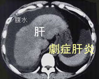 劇症肝炎 CT画像 劇症肝炎 CT画像