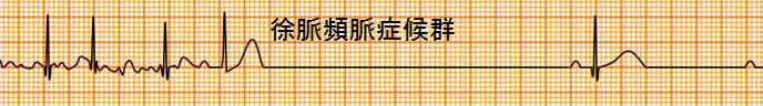 徐脈頻脈症候群 徐脈頻脈症候群