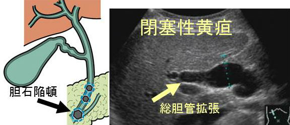総胆管結石 閉塞性黄疸 超音波(エコー)画像 総胆管結石 閉塞性黄疸 超音波(エコー)画像