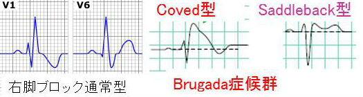 ブルガダ症候群と右脚ブロック ブルガダ症候群と右脚ブロック