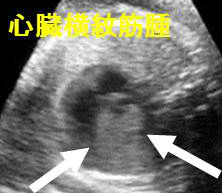 心臓横紋筋腫 心臓横紋筋腫