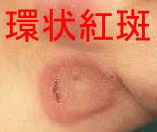 環状紅斑 環状紅斑