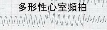 多形性心室頻拍(VT) 多形性心室頻拍(VT)