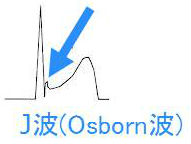 J波症候群 J波症候群