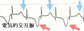 たこつぼ型心筋症の心電図所見 たこつぼ型心筋症の心電図所見