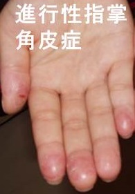 進行性指掌角皮症 進行性指掌角皮症