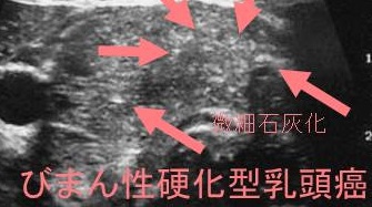 甲状腺びまん性硬化型乳頭癌(DSPTC) 超音波(エコー)画像 甲状腺びまん性硬化型乳頭癌(DSPTC) 超音波(エコー)画像